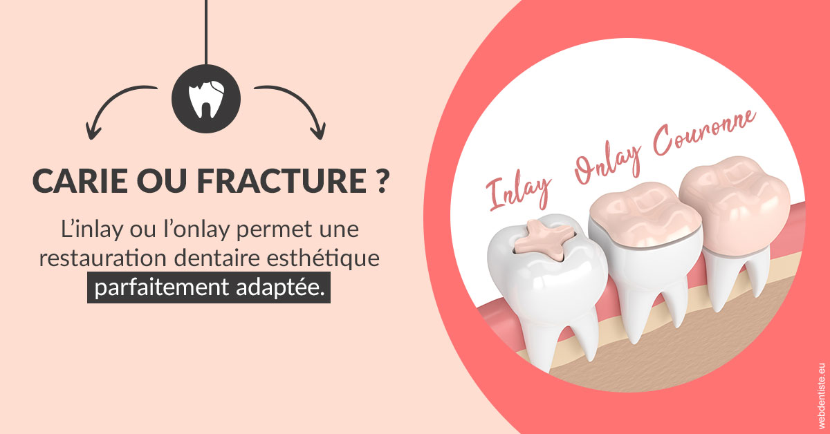 https://dr-leroy-sophie.chirurgiens-dentistes.fr/T2 2023 - Carie ou fracture 2