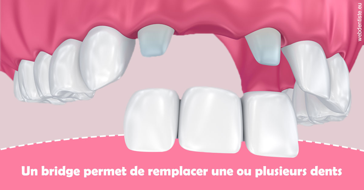 https://dr-leroy-sophie.chirurgiens-dentistes.fr/Bridge remplacer dents 2