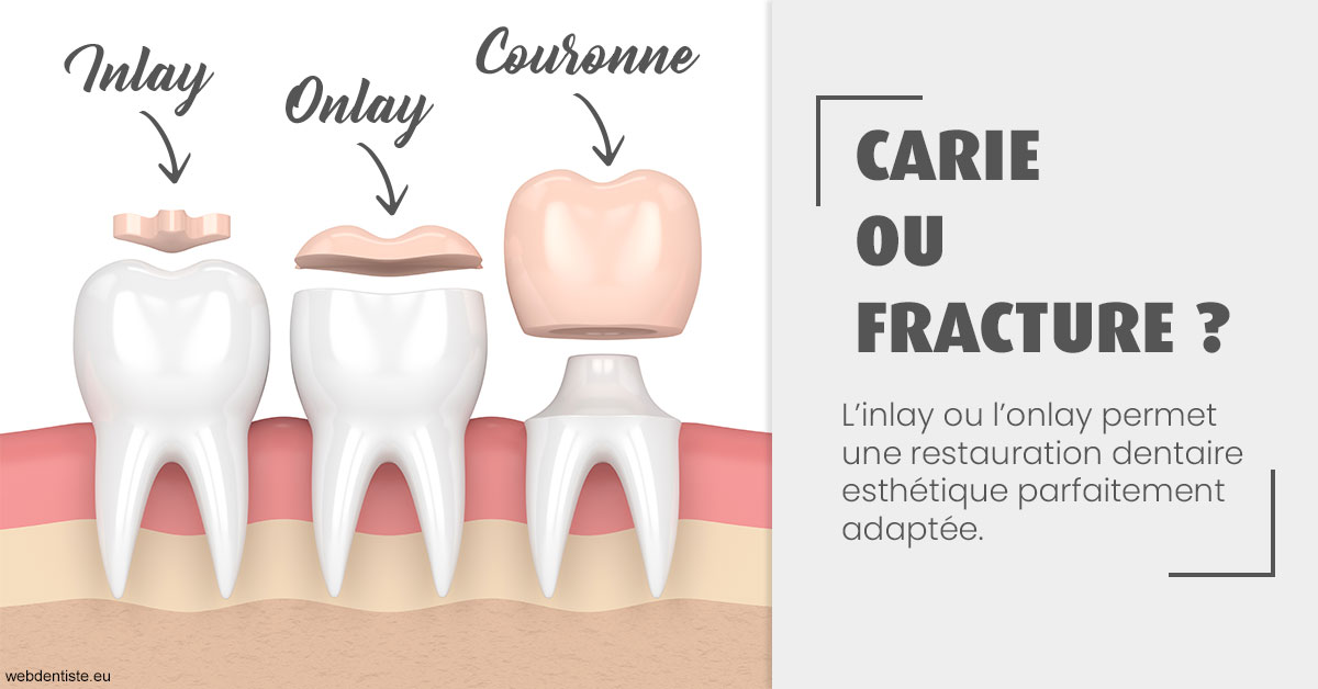 https://dr-leroy-sophie.chirurgiens-dentistes.fr/T2 2023 - Carie ou fracture 1