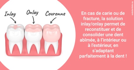 https://dr-leroy-sophie.chirurgiens-dentistes.fr/L'INLAY ou l'ONLAY 2