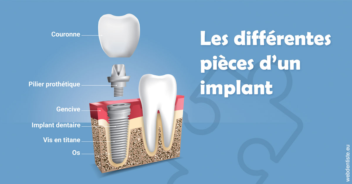 https://dr-leroy-sophie.chirurgiens-dentistes.fr/Les différentes pièces d’un implant 1