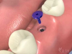 Technique d’implant molaire