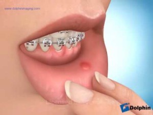 Cire orthodontique